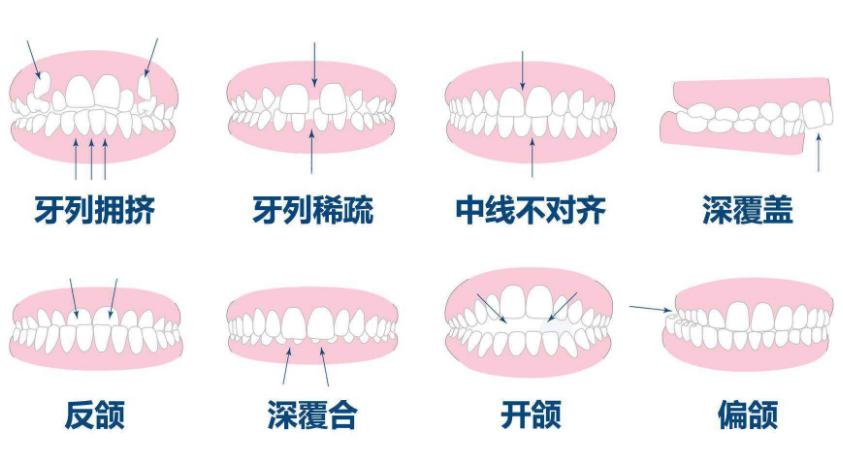 哪些情况需要矫正