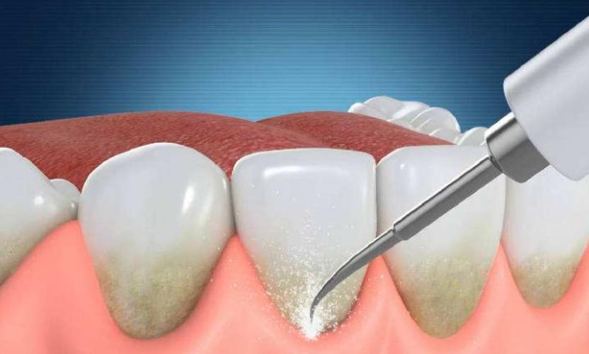种植牙过程是什么样的